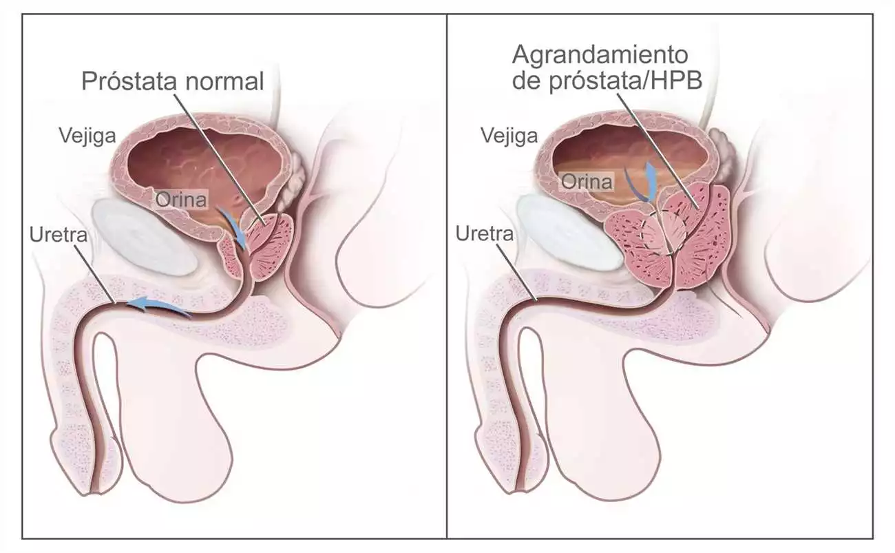 Prostamin en España: la solución natural para la salud de la próstata